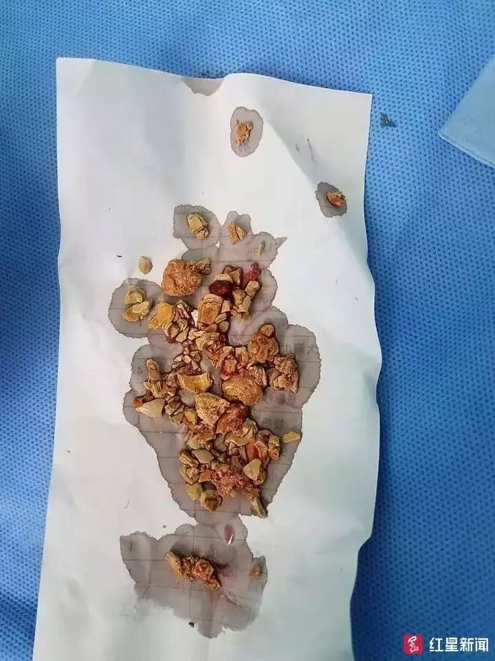 5个月大女婴双肾长满结石！冲泡奶粉的水是问题源头！【每天一个冷知识系列（41）】