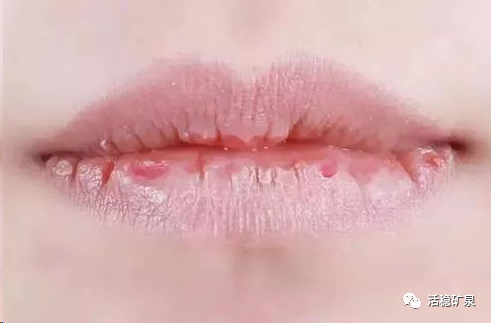冬季预防嘴唇干裂的方法，你都了解吗？【每天一个冷知识系列（61）】
