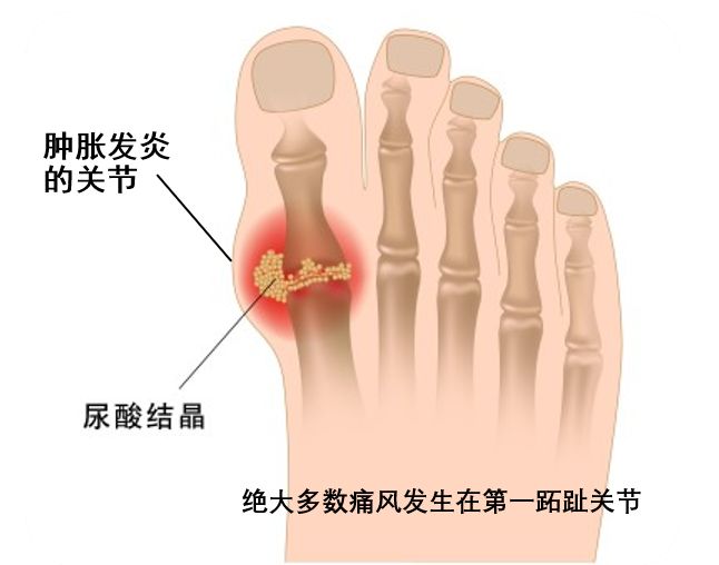 尿酸高哪些器官易受损？医生：再不喝水就晚了…【每天一个冷知识系列（100）】